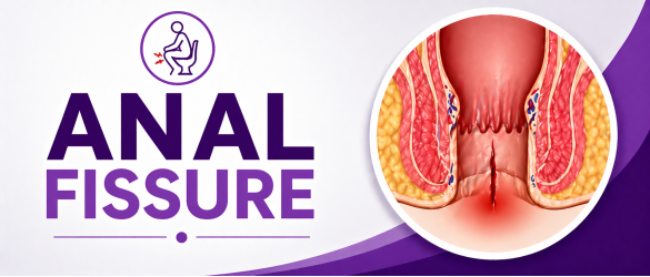 Anal fissure treatment pain relief and rectal tear healing
